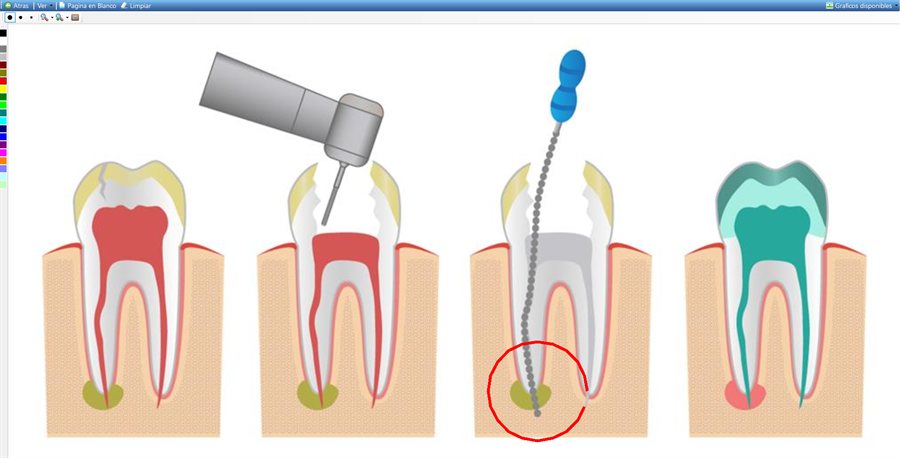 La pizarra de demostraciones con un gráfico de endodoncia y un círculo rojo dibujado a mano sobre una de las piezas; a la izquierda la tira de colores.